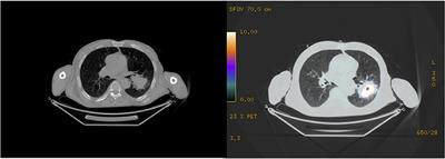 Case Report: COVID-19 Pneumonia Following Left Pneumonectomy for Lung Cancer Complicated by Empyema and Bronchopleural Fistula